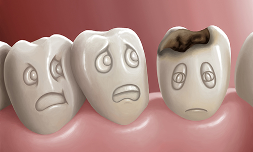 3 home remedies for tooth decay and cavities